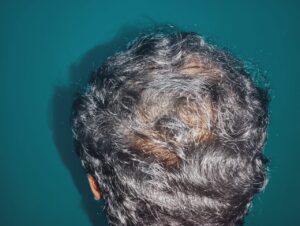 After PRP hair treatment showing improved hair regrowth and increased hair density on the centre head and crown area at Arumeen Aesthetic Centere, Trichy.