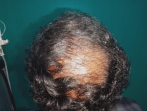Before PRP hair treatment showing centre head baldness and thinning hair on the crown area in a patient at Arumeen Aesthetic Centere, Trichy.