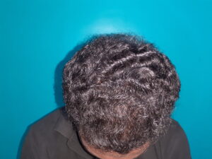 After PRP hair treatment showing improved hair density and natural hair regrowth in a curly-haired male patient at Arumeen Aesthetic Centere, Trichy.