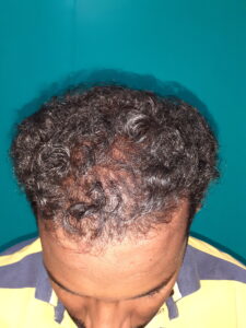 Before PRP hair treatment showing hair thinning and reduced hair density in a curly-haired male patient at Arumeen Aesthetic Centere, Trichy.