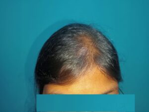 After PRP hair treatment showing improved hair density and natural hair regrowth in a female patient at Arumeen Aesthetic Centere, Trichy.