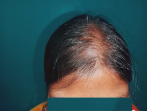 Before PRP hair treatment showing female hair thinning and reduced hair density at Arumeen Aesthetic Centere, Trichy.