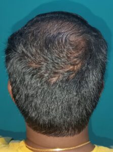 PRP hair treatment before image showing hair thinning and hair loss in a male patient at Arumeen Aesthetic Centere, Trichy.