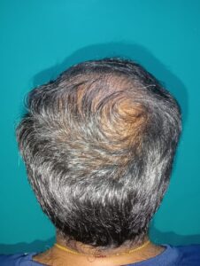 PRP hair treatment after image showing improved hair density and natural hair regrowth at Arumeen Aesthetic Centere, Trichy.